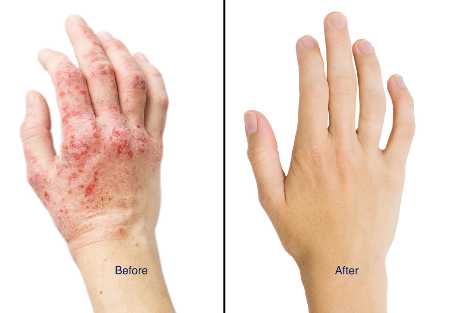Eczema hands before after Hands before and after eczema treatment
