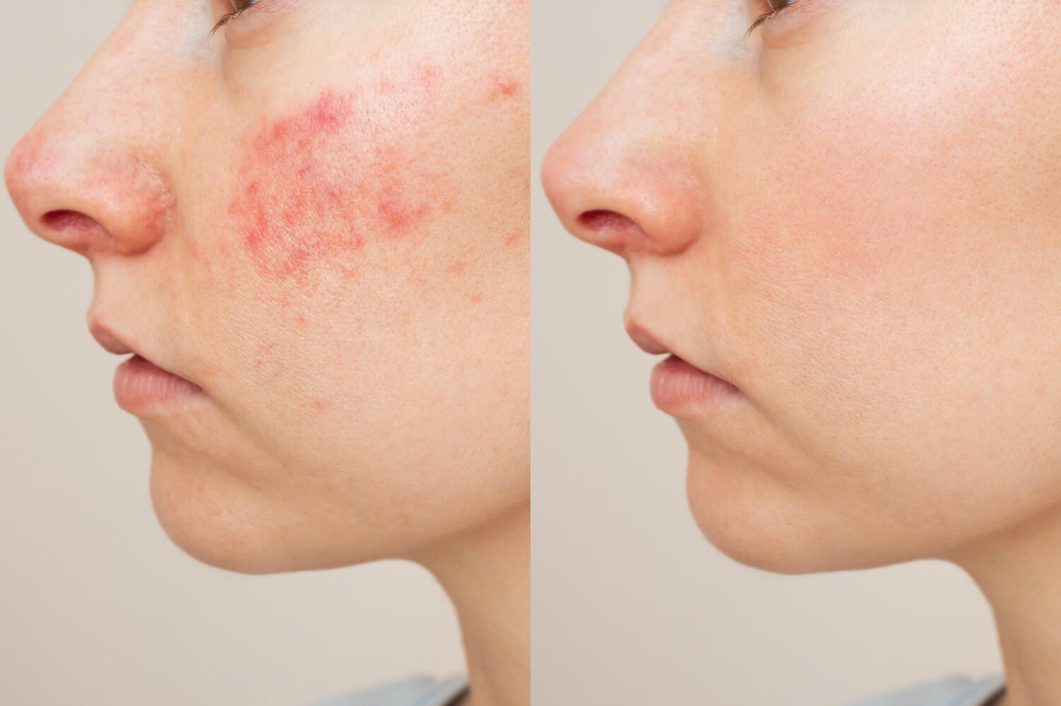 Eczema face before after Face before and after eczema treatment